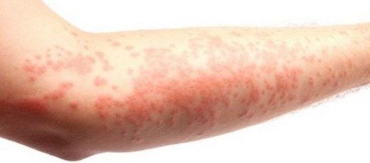 Stres Egzaması Belirtileri ve Tedavisi