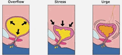Stres İnkontinans Tedavisi